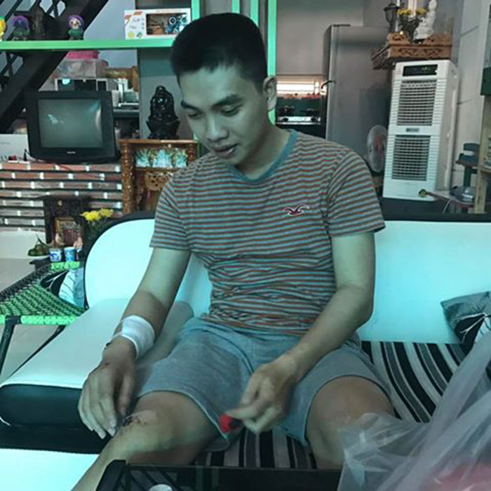 ​Những vết sẹo xuất hiện trên khắp cơ thể chàng trai thư sinh trẻ tuổi Nguyễn Lê Hoài Nam sau tai nạn