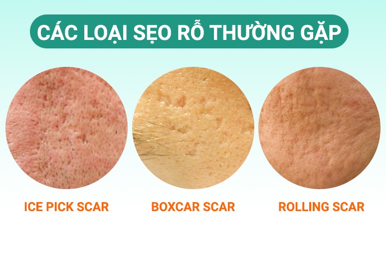 các loại sẹo rỗ 