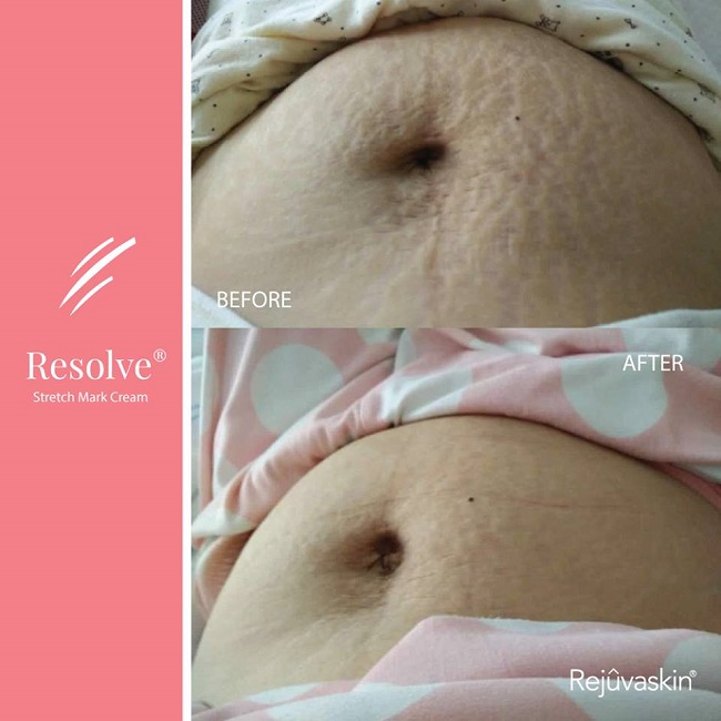 Hiệu quả sau khi sử dụng kem trị rạn da Rejuvaskin được chị Thanh Hiên cung cấp