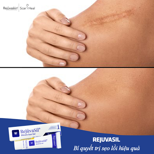 Review kem làm mờ sẹo scar esthetique