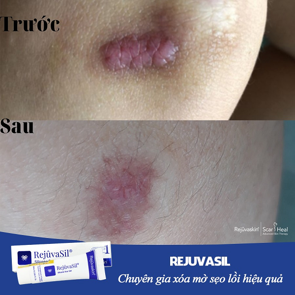 Review kem làm mờ sẹo scar esthetique