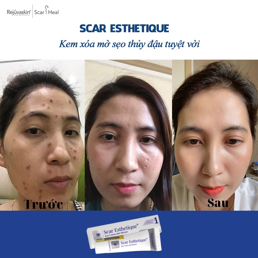 Kem làm mờ sẹo mua nhiều nhất 