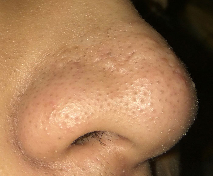 Sẹo rỗ do mụn đầu đen ở mũi