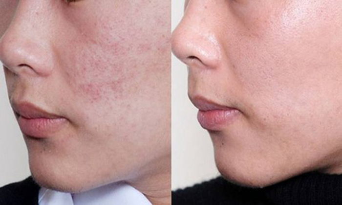 ​Kiên trì sử dụng sau 5 tháng và thành quả của bạn Lâm là làn da  đều màu