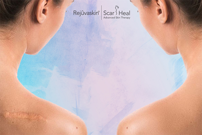 Gel làm mờ sẹo Scar Rejuvasil sử dụng có hiệu quả không? Gel làm mờ sẹo Scar Rejuvasil sử dụng có hiệu quả không?