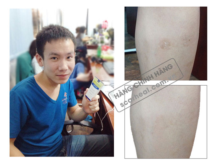 Vết chó cắn của Anh Danh cũng được điều trị như chưa từng xuất hiện