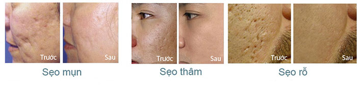 Kem tri seo Scar Esthetique hieu qua tot voi nhieu loai seo: seo mun, seo tham, seo ro