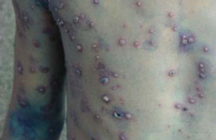 thủy đậu dễ gây ra sẹo rỗ sẹo lõm khó điều trị