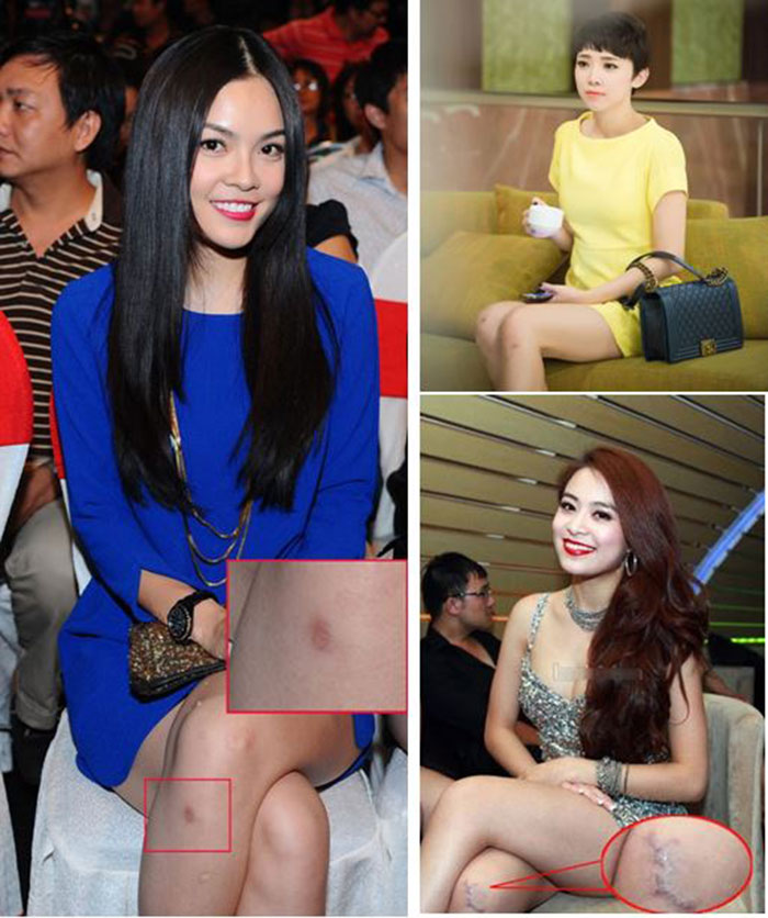 Dù gương mặt hay vóc dáng bạn có xinh đẹp, quyến rũ đến đâu nhưng một khi sẹo đã hiện hữu thì bạn sẽ hoàn toàn bị mất điểm trầm trọng Dù gương mặt hay vóc dáng bạn có xinh đẹp, quyến rũ đến đâu nhưng một khi sẹo đã hiện hữu thì bạn sẽ hoàn toàn bị mất điểm trầm trọng