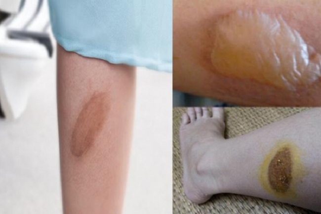 cach tri seo lom sau bong