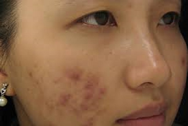 cach tri seo ro do mun