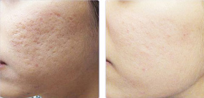 ​Kết quả sau 3 tháng sử dụng kem làm mờ sẹo Esthetique của bạn Hùng