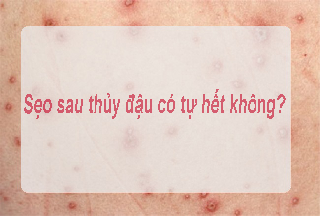 Sẹo thâm sau thủy đậu có tự hết không Seo tham sau thuy dau co tu het khong