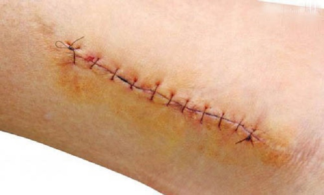 Cách làm mờ sẹo lõm sau phẫu thuật Cach ngan ngua seo lom sau phau thuat