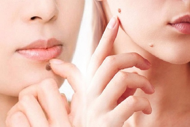 cach tri seo sau tay noi ruoi