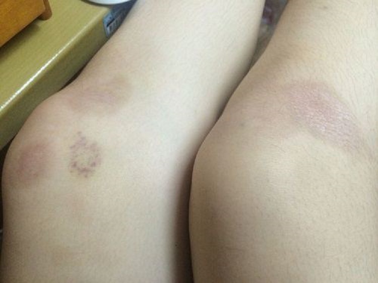 cách làm mờ sẹo ở chân cach tri seo o chan