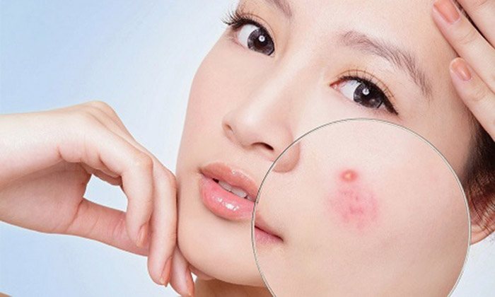 vết thâm mụn ở mặt