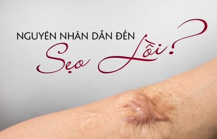 kem làm mờ sẹo lồi tốt nhất