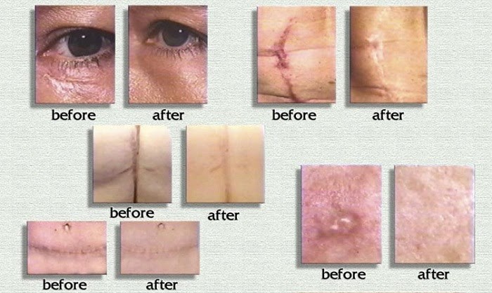 trước và sau khi làm mờ sẹo lồi trước và sau khi tri sẹo lồi