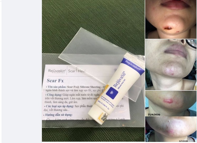 Phản hồi về kem làm mờ sẹo lồi Rejuvasil