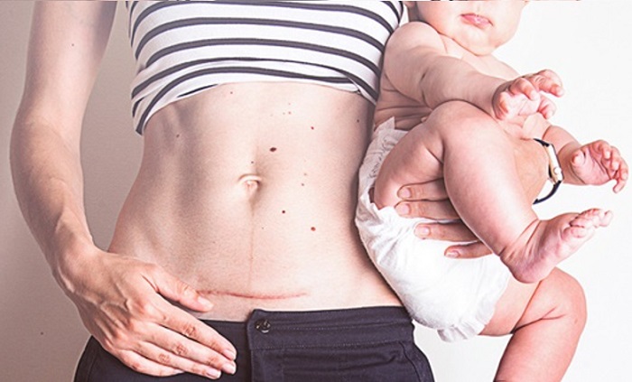 Kem làm mờ sẹo mổ đẻ hiệu quả.