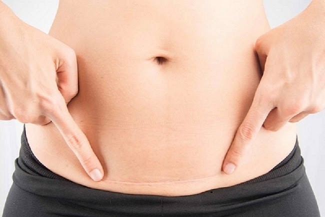 Kiên trì sử dụng kem làm mờ sẹo mổ đẻ sau 1 thời gian sẹo sẽ mờ đi