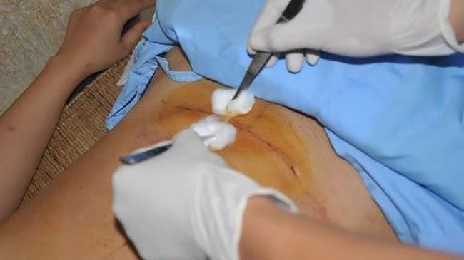 Vệ sinh vết sẹo đúng cách giúp ngăn ngừa sẹo hình thành tối đa