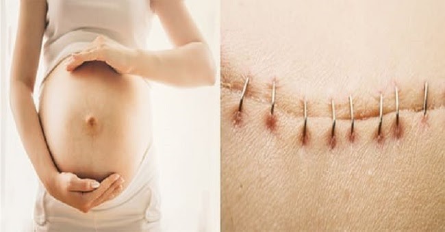 Sinh mổ rất khó tránh khỏi nguy cơ bị sẹo lồi xấu trên da