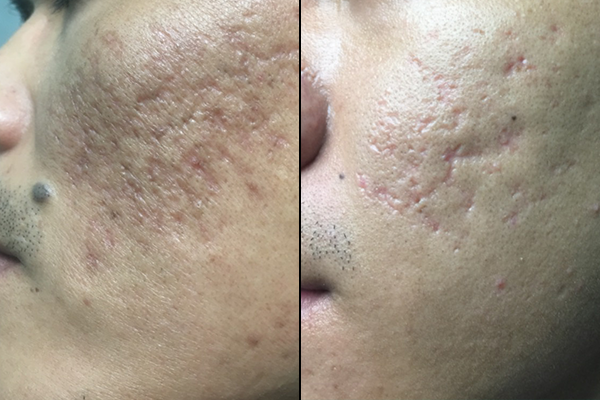 Kết quả sử dụng kem làm mờ sẹo Scar Esthetique sau 1 tháng. Kết quả sử dụng kem làm mờ sẹo Scar Esthetique sau 1 tháng.