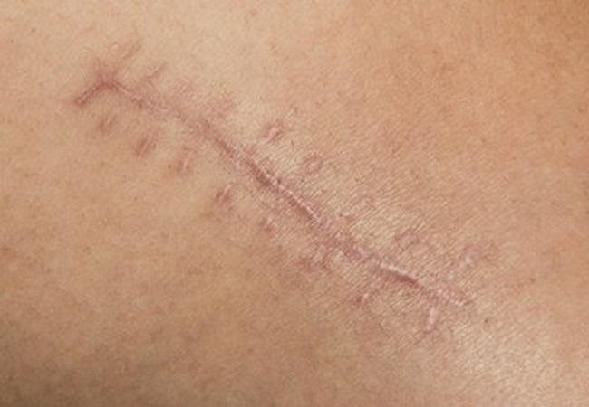 Sẹo phì đại sau phẫu thuật để lại