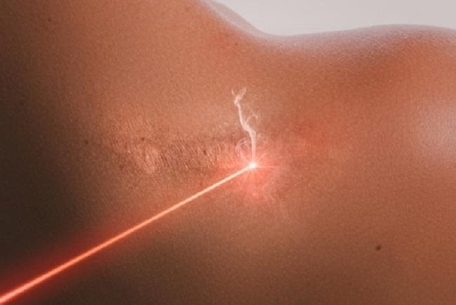 Làm mờ sẹo phì đại bằng công nghệ Laser