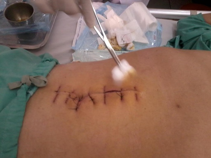 chăm sóc vết thương sau phẫu thuật