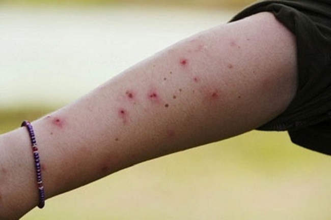 Vết sẹo thâm do muỗi đốt