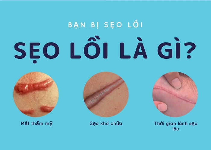 seo loi la gi