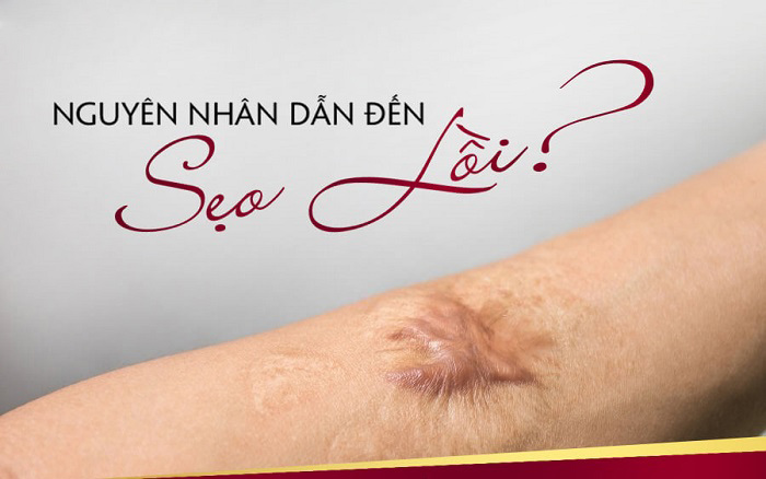 NGUYEN NHAN GAY SEO LOI