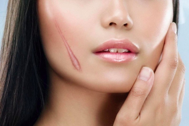 6 mẹo chữa sẹo lồi dân gian hiệu quả bất ngờ ngay tại nhà