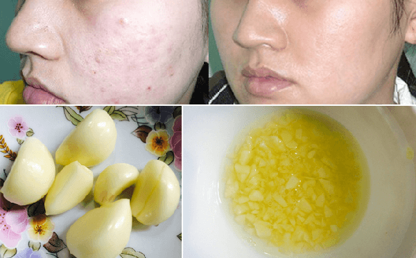 8 cách làm mờ sẹo lồi trên mặt hiệu quả