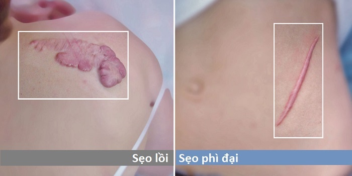 Phân biệt sẹo lồi và seo phì đại phan biet seo loi va seo phi dai