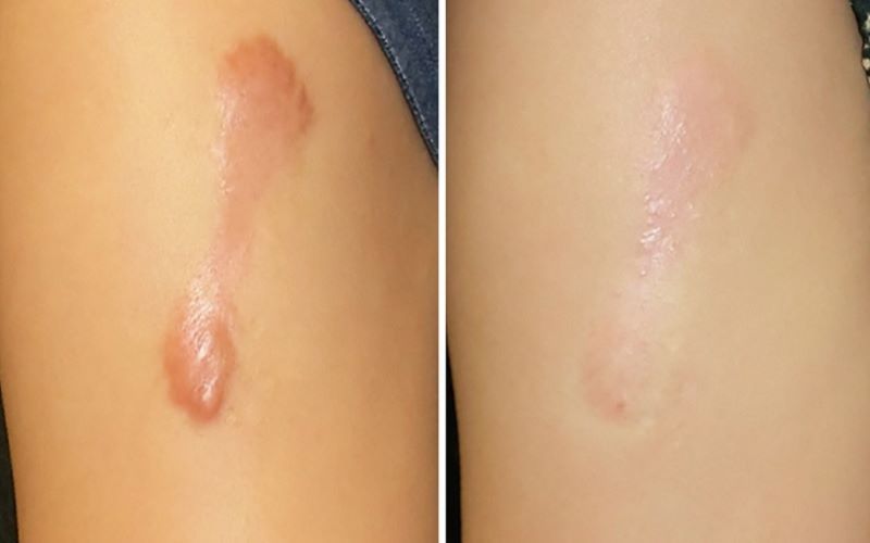 Corticosteroid đã được chứng minh là giúp làm mờ sẹo lồi thông qua nhiều cơ chế khác nhau Corticosteroid đã được chứng minh là giúp làm mờ sẹo lồi thông qua nhiều cơ chế khác nhau