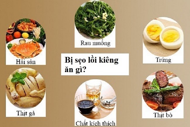 Thực phẩm cần kiêng sau khi cắt mí