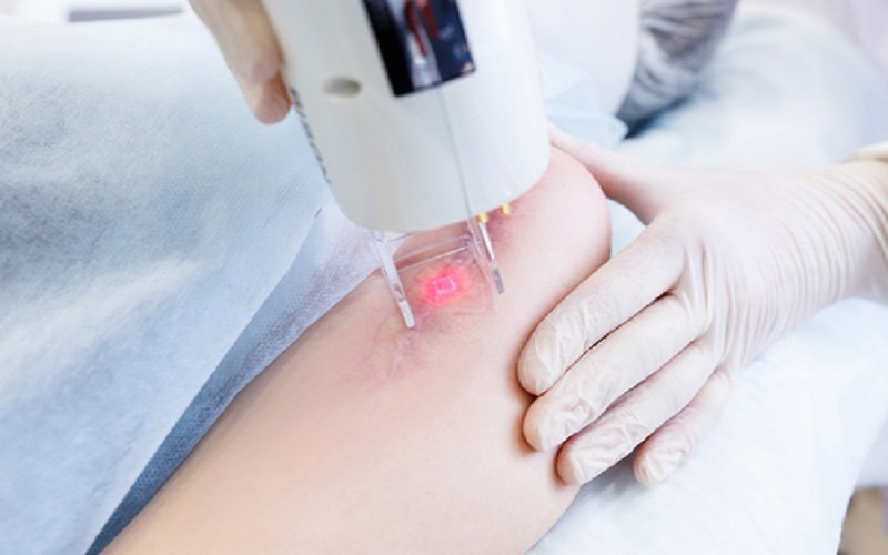 Liệu pháp Laser