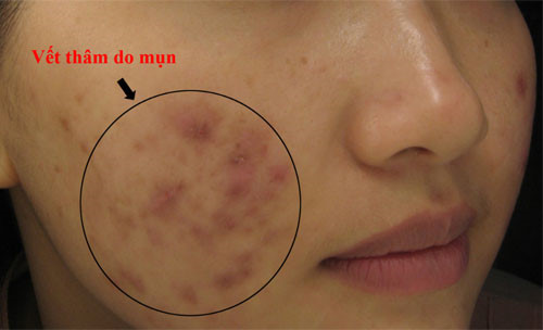 Mụn thường để lại những vết thâm và sẹo rỗ trên gương mặt