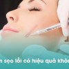 Tiêm sẹo lồi là gì? Có hiệu quả và an toàn không? Bao lâu thì xẹp?