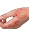 Sẹo bỏng và những điều cần biết khi làm mờ sẹo lõm sau bỏng