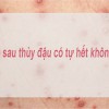 Bí quyết xóa sẹo thâm sau khi bị thủy đậu mà không cần nhiều thời gian