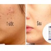 Tiết lộ cách làm mờ sẹo lâu năm hiệu quả mà ít tốn kém nhất