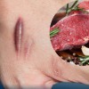 Ăn thịt bò có bị sẹo lồi không? Nên ăn gì để tránh sẹo lồi?