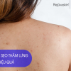 Bật Mí Top 2 Cách Làm Mờ Sẹo Thâm Ở Lưng Cấp Tốc