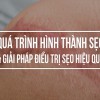 Top 7 cách làm mờ sẹo tại nhà hữu hiệu nhất hiện nay
