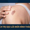 7 cách làm mờ sẹo lồi mới hình thành hiệu quả dứt điểm ngăn ngừa tái phát